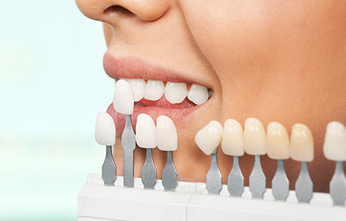 オリオン歯科・矯正歯科のホワイトニング